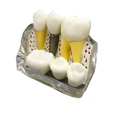 Dentier clair 4 fois modèle d'implantation modèle d'implant amovible couronne de pontage modèle