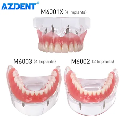 AZDENT-Modèle de Dents d'Implant Dentaire Prothèse Mandibulaire Intérieure avec Implants Dent
