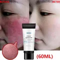 Crème réparatrice des rougeurs du visage améliore les peaux sensibles traitement instantané des