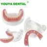 Zahn implantat modell mit abnehmbarer Brücke 4 Implantate Over prothese minderwertige Demo