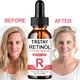 SDP Retinol Face Serum 2.5% With Hyaluronic Acid Anti Wrinkle Whitening Moisturizing Brightening