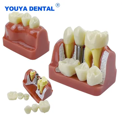 Dental 4 Times Implant Teeth model Analysis Crown Bridge Demonstration Removable Model Dentisty