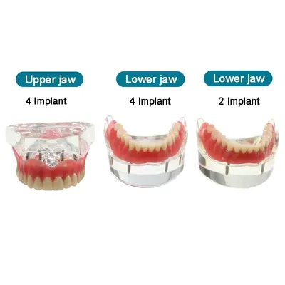 Dental Teeth Model with Implant Overdenture Inferior Demo Mandibular Model Dentist Student Learning