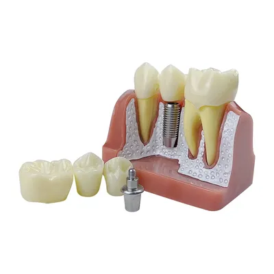 Decorative Analysis Model Crown Bridge Demonstration Teaching Model, Removable Training Study, 4