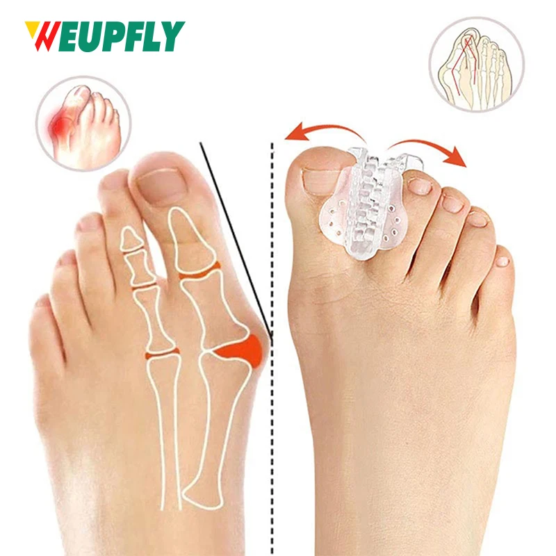 1 Paar Bunion Corrector & Zehenspreizer – verstellbare Big-Toe-Abstandshalter für überlappende Zehen, Linderung von Hallux Valgus Image