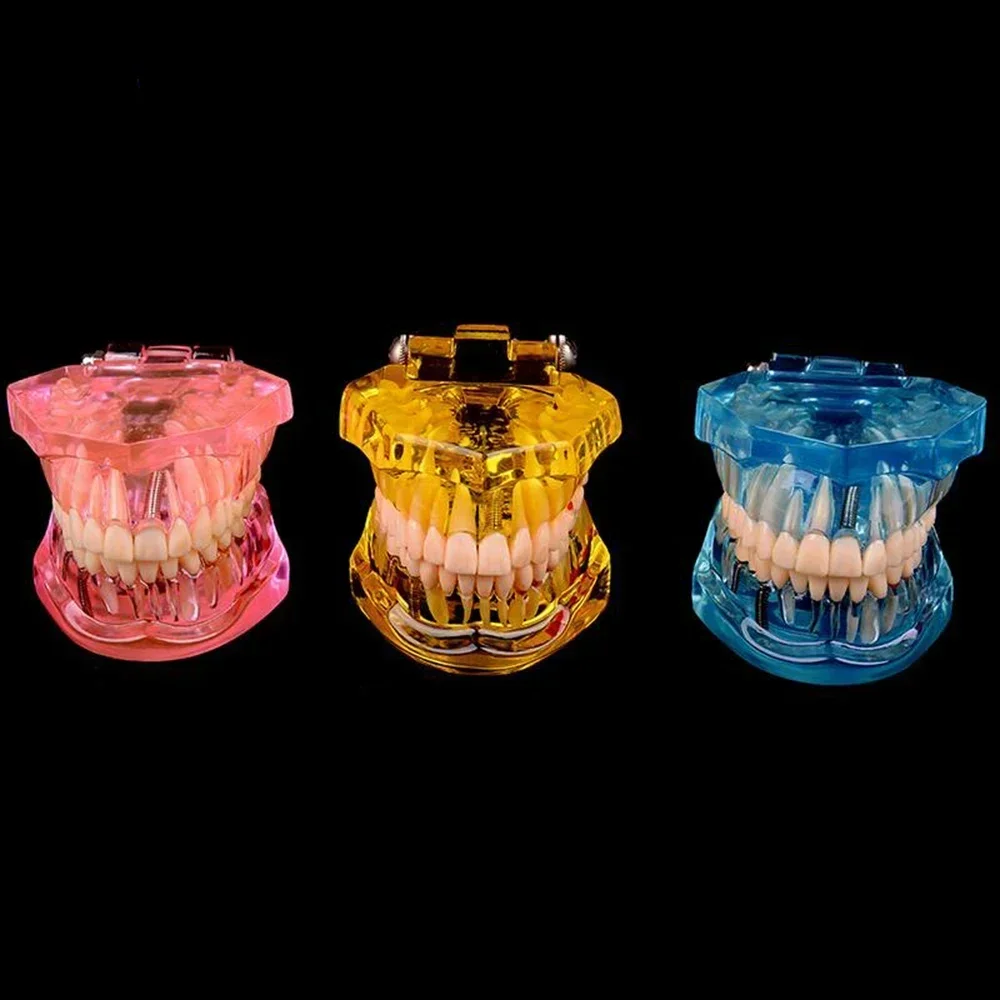 Dentalmodelle Abnehmbare und regenerierende Modelle von erkrankten Zähnen für den Unterricht und Forschung medizinischer und zahnmedizinischer Krankheiten Image