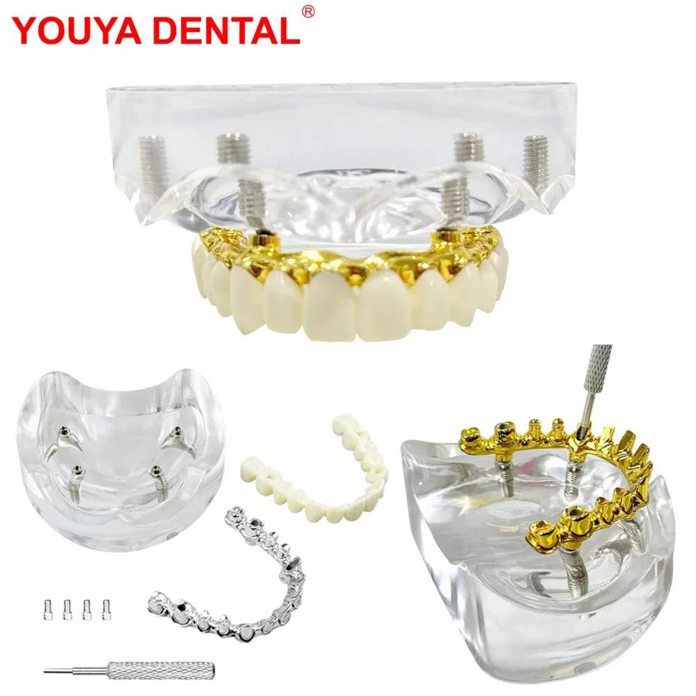 Zahnimplantatmodell mit Wiederherstellung, 4 Implantate, obere Kiefer, abnehmbares Zahnmodell, Overdenture für die Demonstration von Zahnheilkunde Image