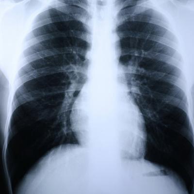 Clear Choice Performance X-Ray Film 14 X 17 Inch Medium Speed Green Sensitive High (456480_BX) 100/BX Clear Choice™ Performance Miscellaneous Disposab