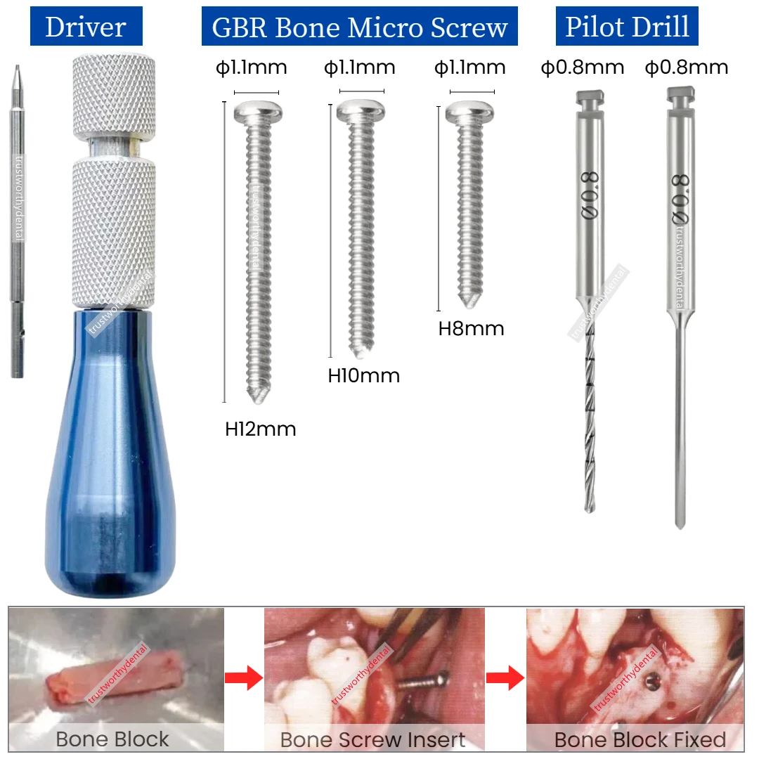 Dental Micro Bone Screw GBR Bone Block Fixing Zelt Screw Bone Fixation with Handle Pilot Drill GBR SLT Guided Bone Regeneration Image