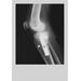 Buyenlarge 'Knee Replacement' Graphic Art Print Paper in White | 36 H x 24 W x 1.5 D in | Wayfair 0-587-11733-8C2436